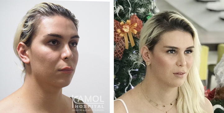 Cirurgia de Feminização Facial / FFS 64 lg 64949589e0bee image