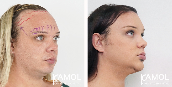 Cirurgia de Feminização Facial / FFS 69 lg 6494958a00782 image