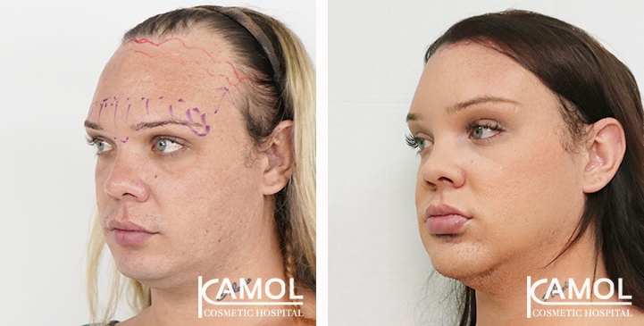 Cirurgia de Feminização Facial / FFS 70 lg 6494958a02994 image