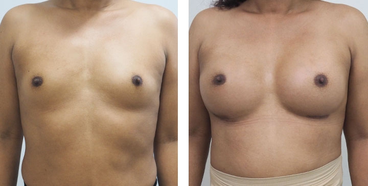 Cirurgia de Mama para Mulheres Trans 2 lg 6494958a0b136 image