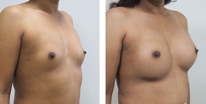Cirurgia de Mama para Mulheres Trans 4 lg 6494958a0f04b image