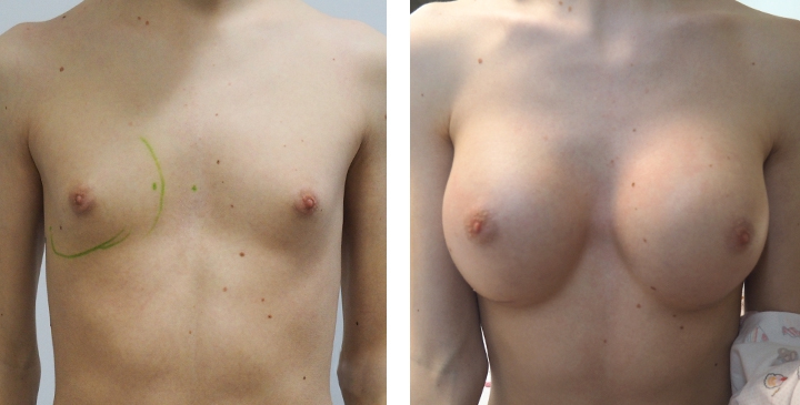 Cirurgia de Mama para Mulheres Trans 6 lg 6494958a118e7 image