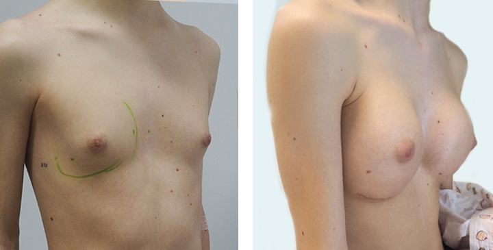 Cirurgia de Mama para Mulheres Trans 8 lg 6494958a15751 image