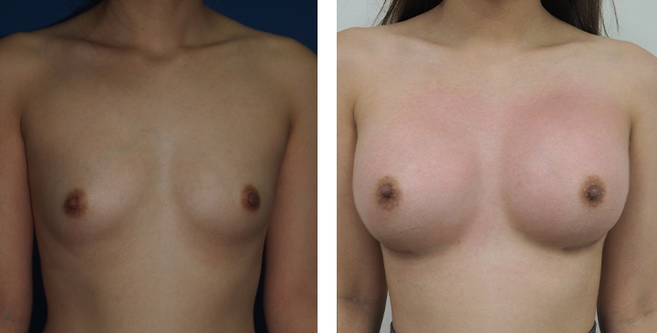 Cirurgia de Mama para Mulheres Trans 10 lg 6494958a17ff7 image 2