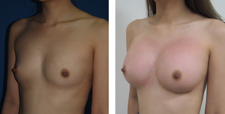 Cirurgia de Mama para Mulheres Trans 11 lg 6494958a19dcb image