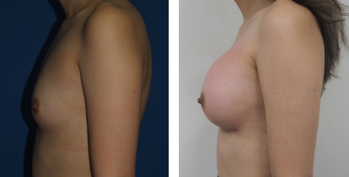 Cirurgia de Mama para Mulheres Trans 12 lg 6494958a1bbe0 image