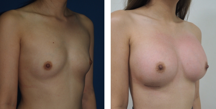 Cirurgia de Mama para Mulheres Trans 13 lg 6494958a1da33 image