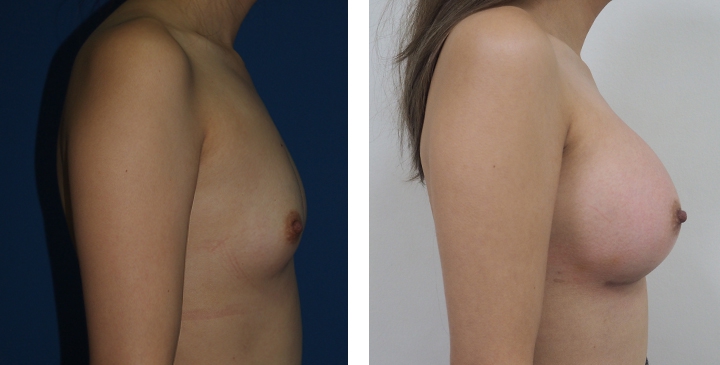 Cirurgia de Mama para Mulheres Trans 14 lg 6494958a1fa87 image