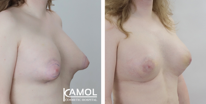 Cirurgia de Mama para Mulheres Trans 19 lg 6494958a261c5 image