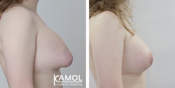 Cirurgia de Mama para Mulheres Trans 18 lg 6494958a29b59 image