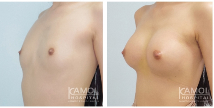 Cirurgia de Mama para Mulheres Trans 23 lg 6494958a2df56 image
