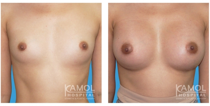 Cirurgia de Mama para Mulheres Trans 25 lg 6494958a306ee image