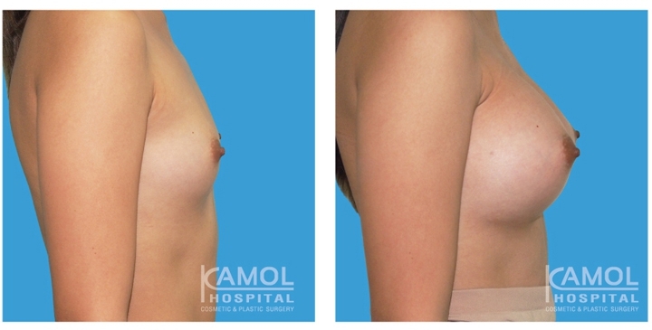Cirurgia de Mama para Mulheres Trans 27 lg 6494958a33f60 image