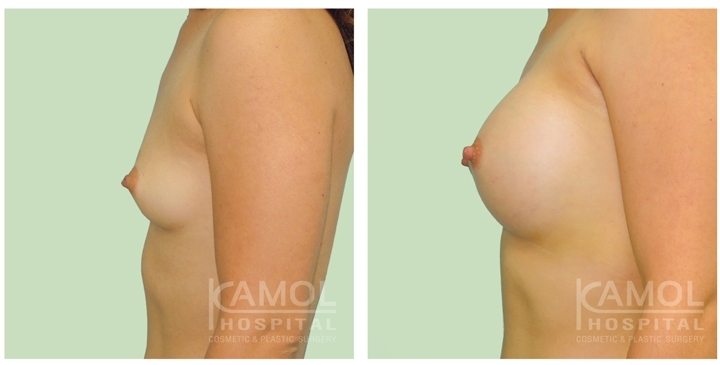 Cirurgia de Mama para Mulheres Trans 30 lg 6494958a3a5e1 image 1