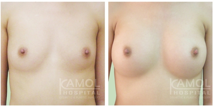 Cirurgia de Mama para Mulheres Trans 33 lg 6494958a3ed84 image