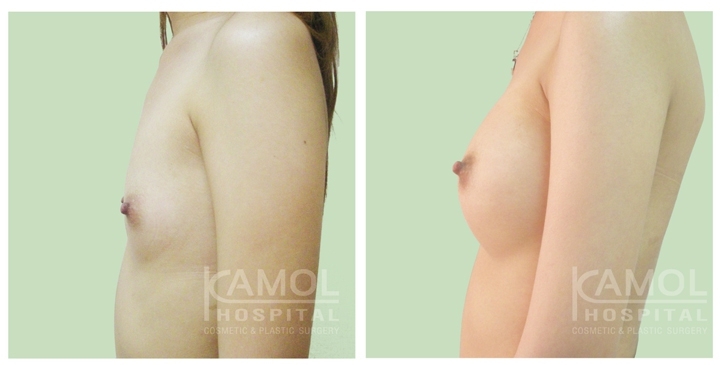 Cirurgia de Mama para Mulheres Trans 35 lg 6494958a40e18 image