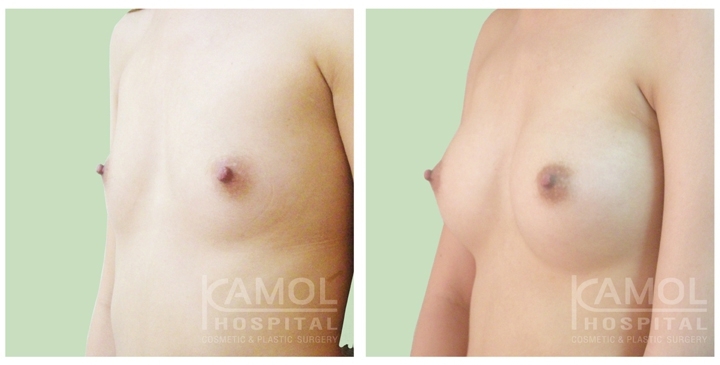Cirurgia de Mama para Mulheres Trans 34 lg 6494958a42b1f image