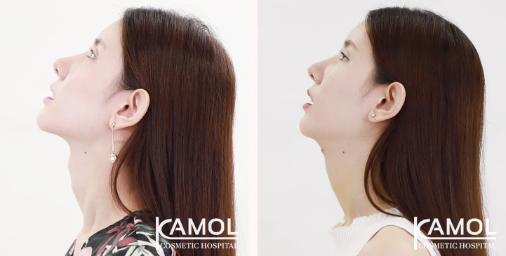 Tracheal Shave 10 lg 6494958a58d52 image