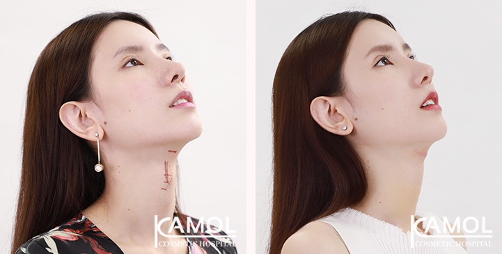 Tracheal Shave 9 lg 6494958a5aed8 image