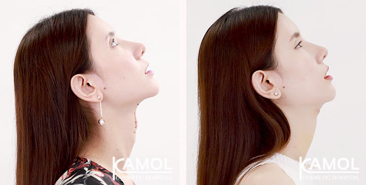 Tracheal Shave 12 lg 6494958a5cebc image