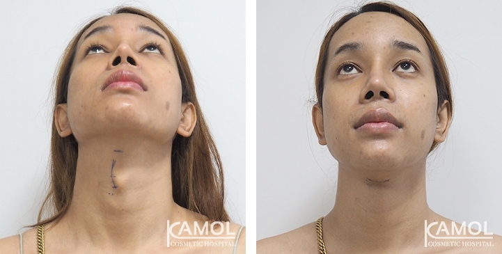 Tracheal Shave 14 lg 6494958a5fa33 image