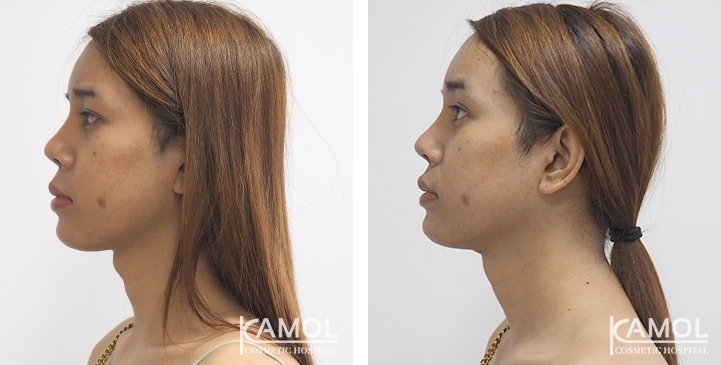 Tracheal Shave 16 lg 6494958a6396b image
