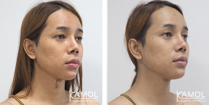 Tracheal Shave 17 lg 6494958a656b5 image