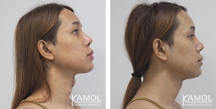 Tracheal Shave 15 lg 6494958a6753c image