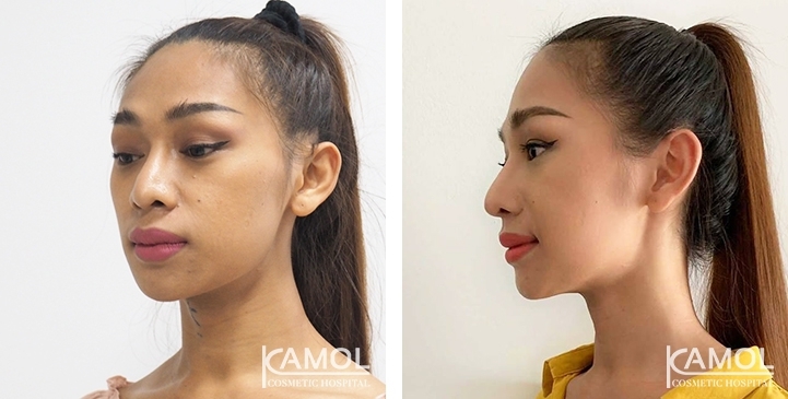 Tracheal Shave 23 lg 6494958a6c649 image