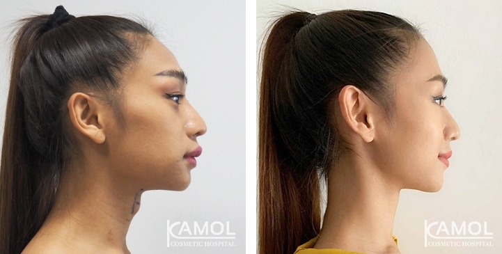 Tracheal Shave 21 lg 6494958a705f2 image