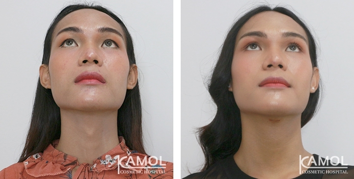 Tracheal Shave 25 lg 6494958a73263 image