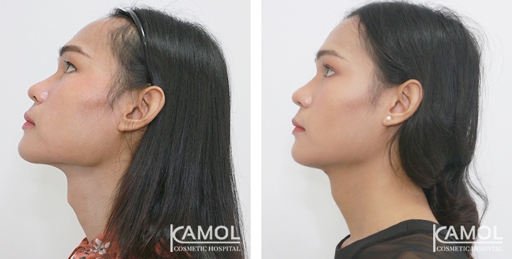 Tracheal Shave 26 lg 6494958a77180 image