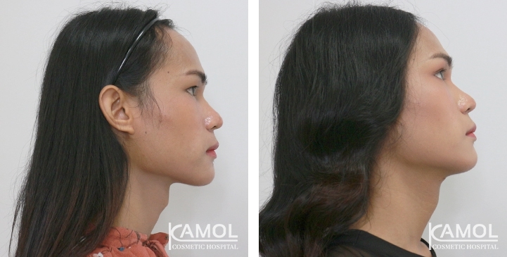 Tracheal Shave 29 lg 6494958a7b41b image