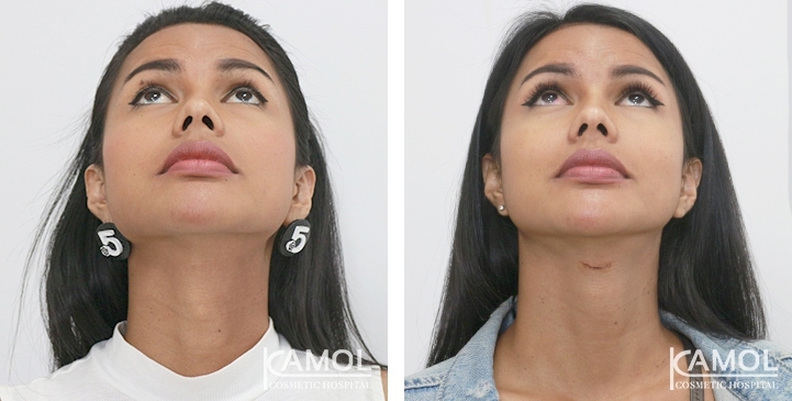 Tracheal Shave 31 lg 6494958a7de85 image