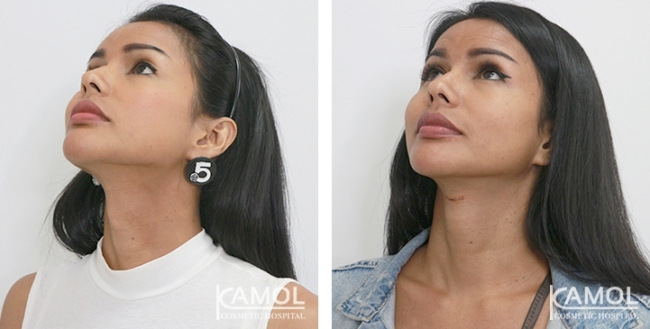 Tracheal Shave 35 lg 6494958a7fde3 image