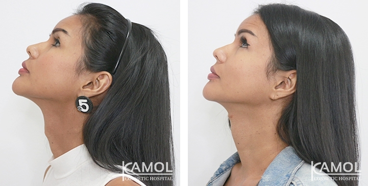 Tracheal Shave 34 lg 6494958a81c55 image