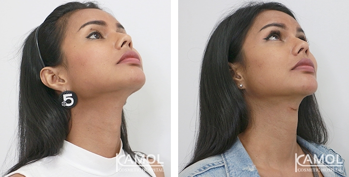 Tracheal Shave 33 lg 6494958a83a99 image