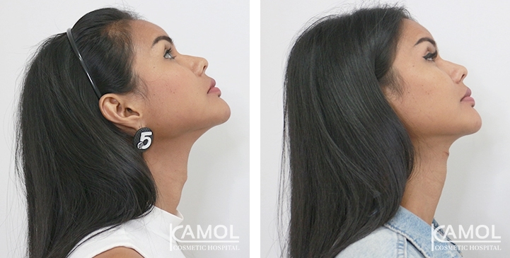 Tracheal Shave 32 lg 6494958a85a42 image