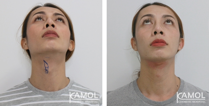 Tracheal Shave 37 lg 6494958a891a4 image
