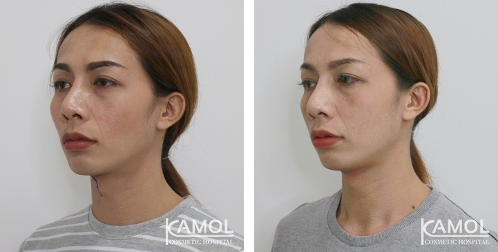 Tracheal Shave 38 lg 6494958a8b315 image