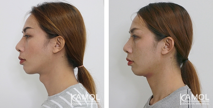 Tracheal Shave 39 lg 6494958a8da2e image