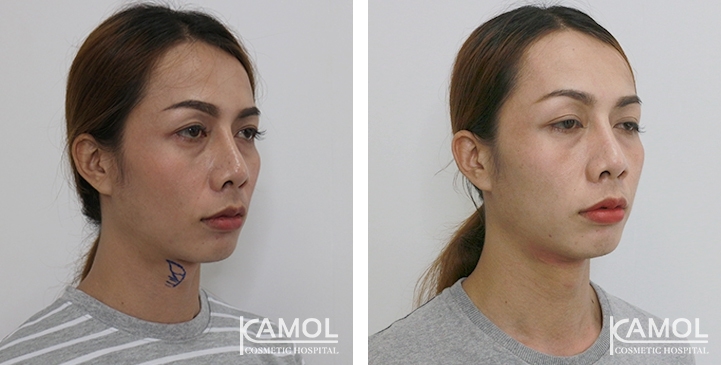 Tracheal Shave 40 lg 6494958b268cf image