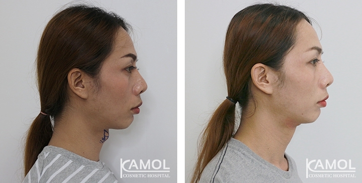 Tracheal Shave 41 lg 6494958d67b8f image