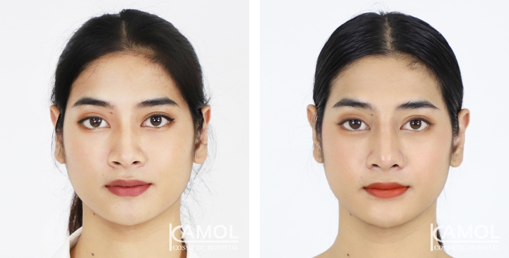 Rinoplastia 14 lg 6494958d7033f image