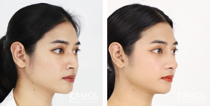Rinoplastia 18 lg 6494958d72ba3 image