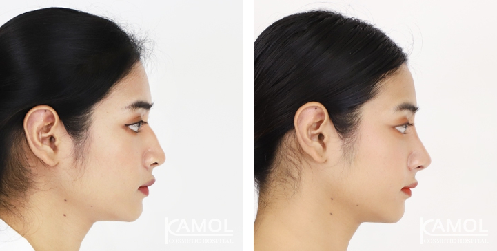 Rinoplastia 17 lg 6494958d74c04 image