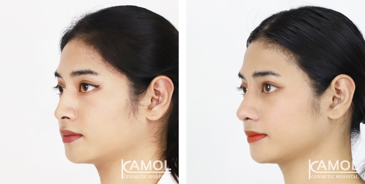Rinoplastia 16 lg 6494958d76d18 image