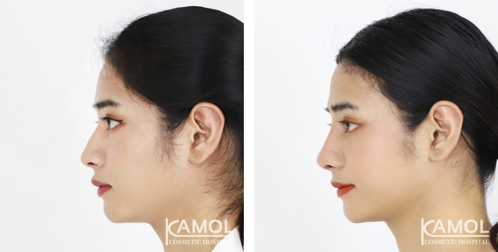 Rinoplastia 15 lg 6494958d78c26 image