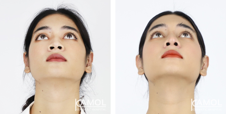 Rinoplastia 19 lg 6494958d7aac3 image