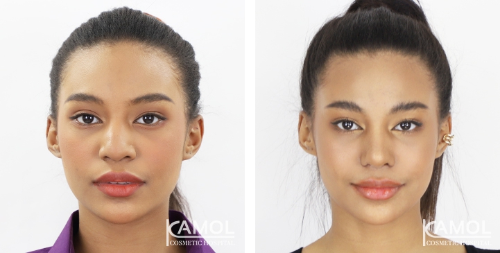 Rinoplastia 21 lg 6494958d7d459 image